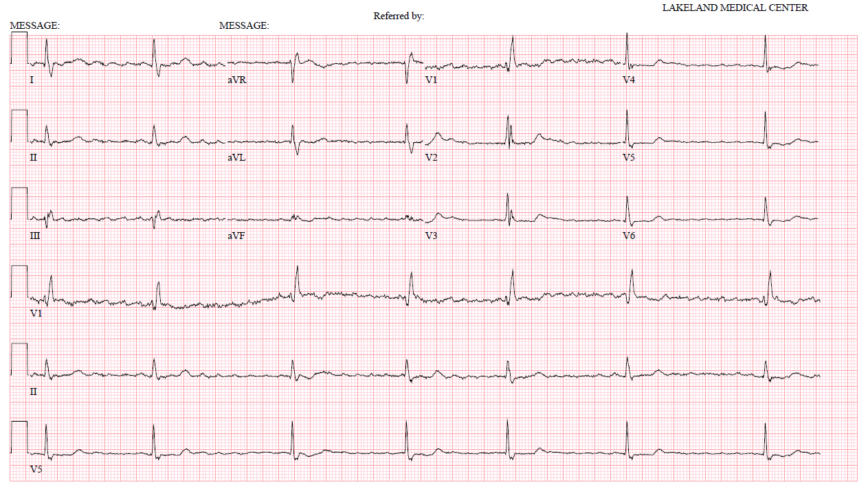 Очаговые изменения на экг. Инфаркт миокарда нижней стенки ЭКГ. Аневризма левого желудочка на ЭКГ. Аневризма сердца на ЭКГ после инфаркта. ЭКГ после шунтирования.